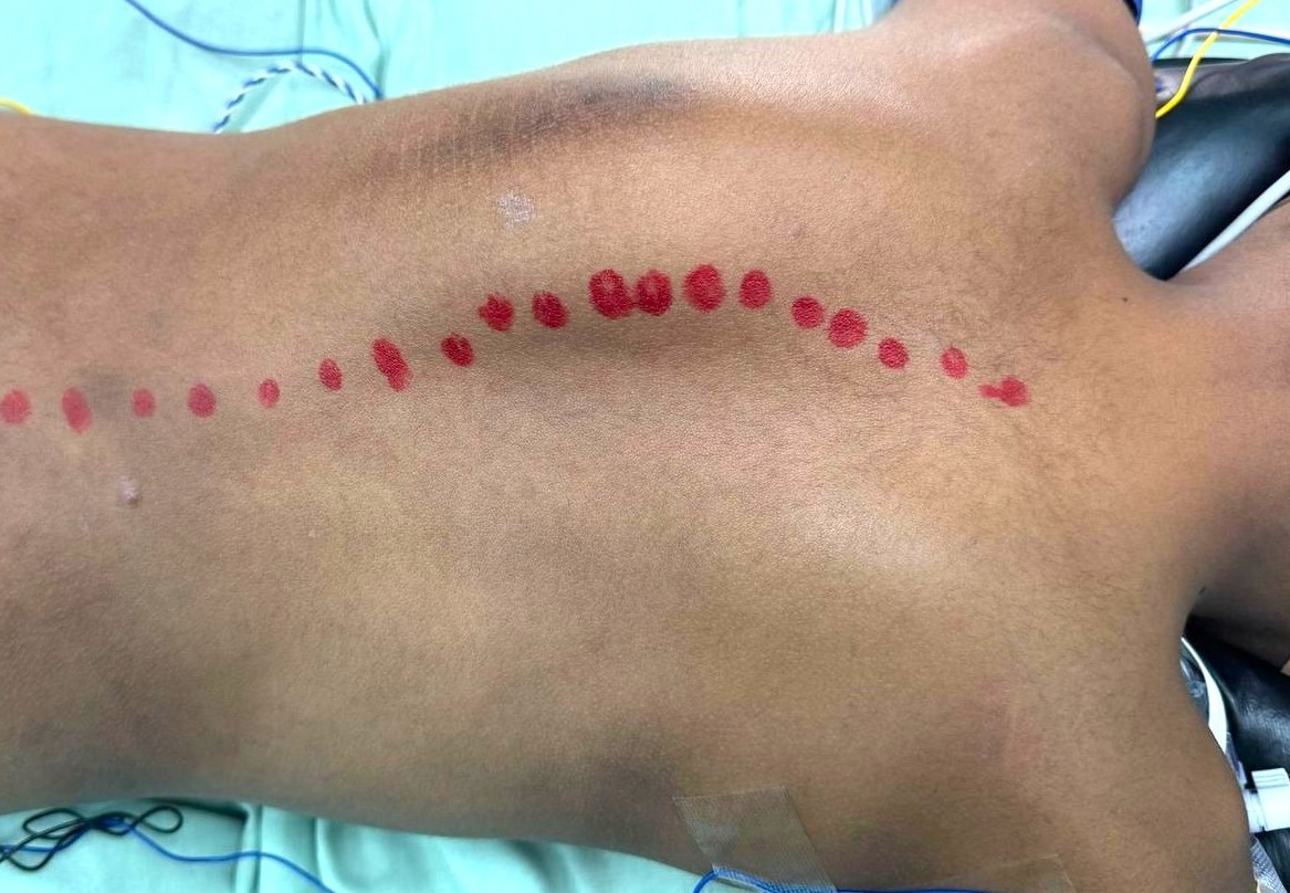Scoliosis Surgery